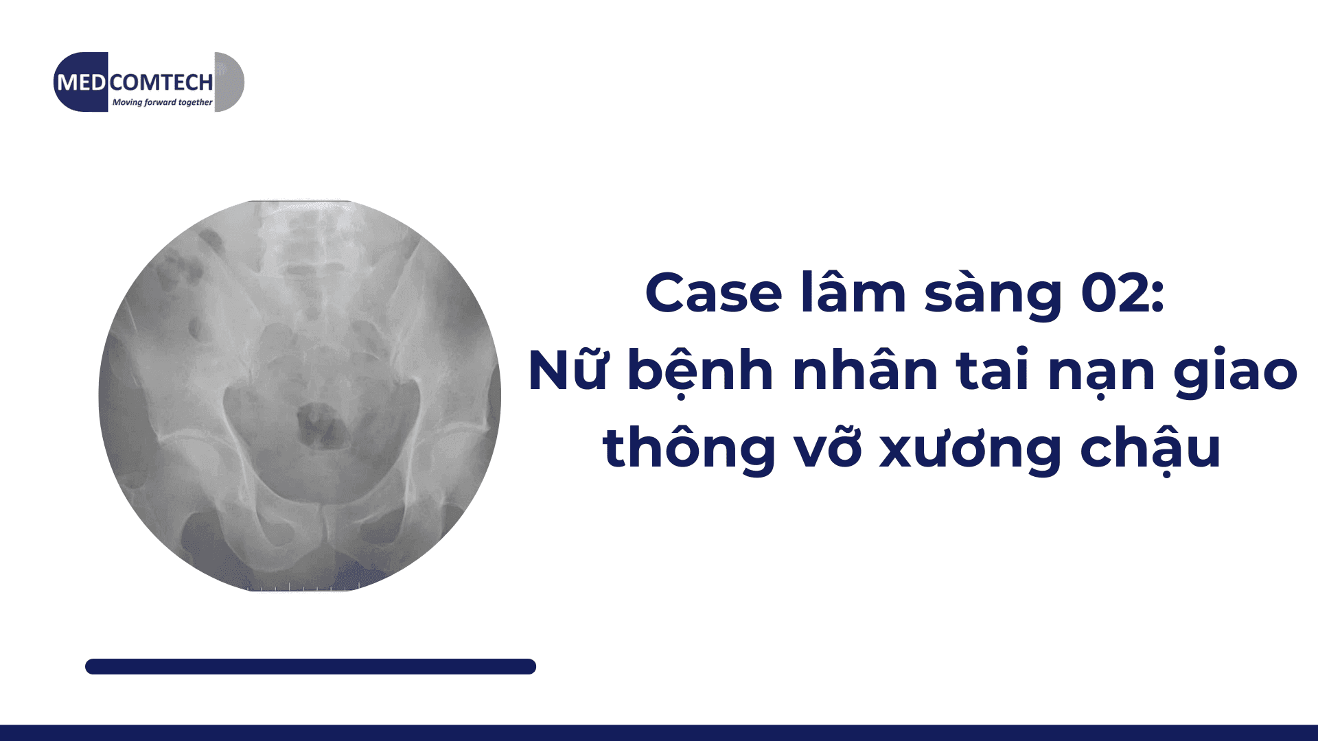 Case lâm sàng 02: Nữ bệnh nhân tai nạn giao thông vỡ xương chậu