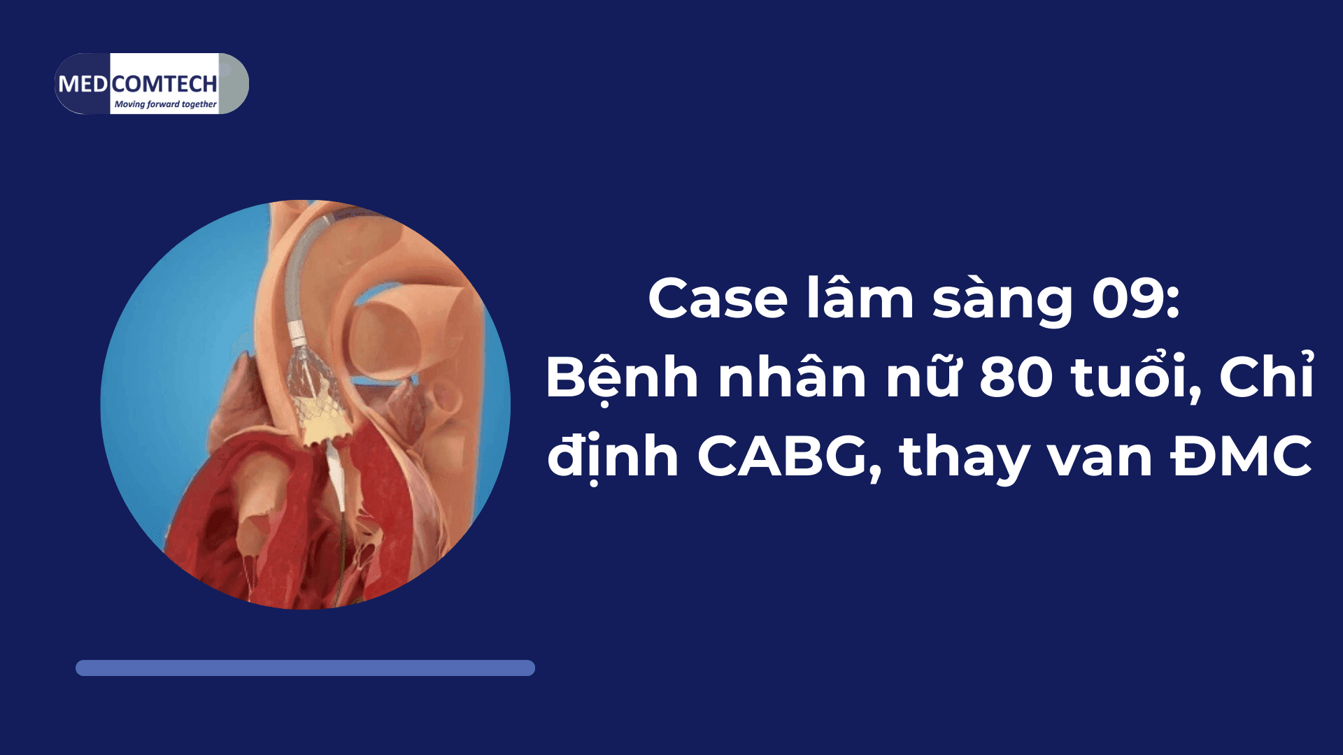 Case lâm sàng 09: Bệnh nhân nữ 80 tuổi, Chỉ định CABG, thay van ĐMC