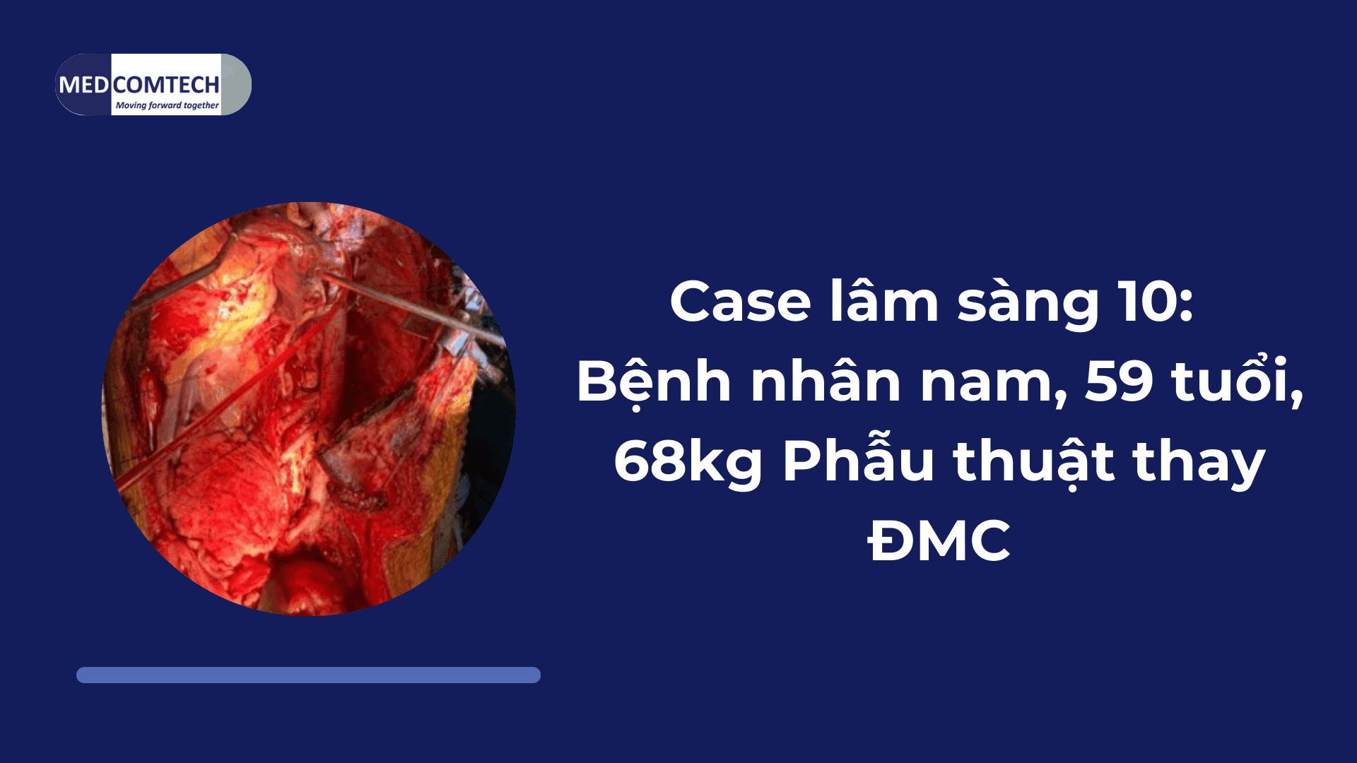 Case lâm sàng 10: Bệnh nhân nam, 59 tuổi, 68kg Phẫu thuật thay ĐMC