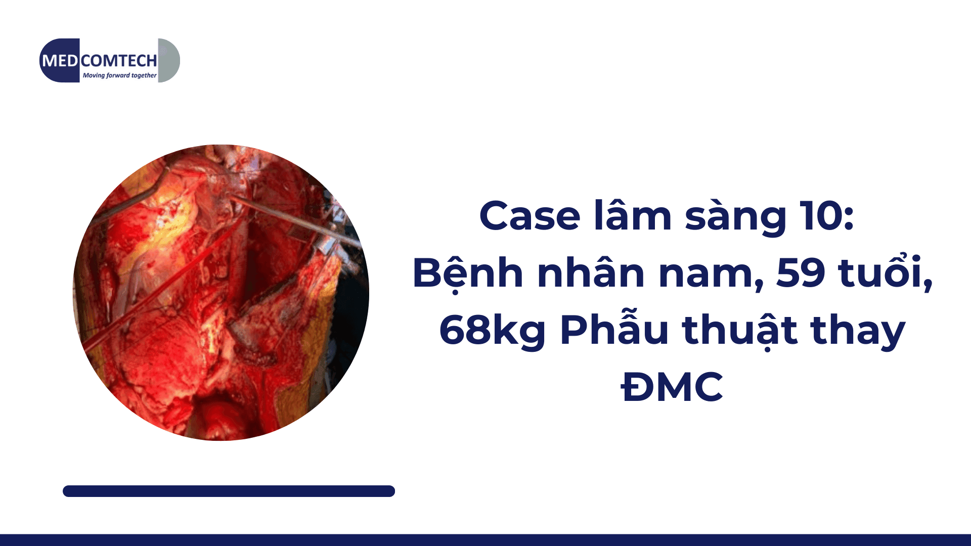 Case lâm sàng 10: Bệnh nhân nam, 59 tuổi, 68kg Phẫu thuật thay ĐMC