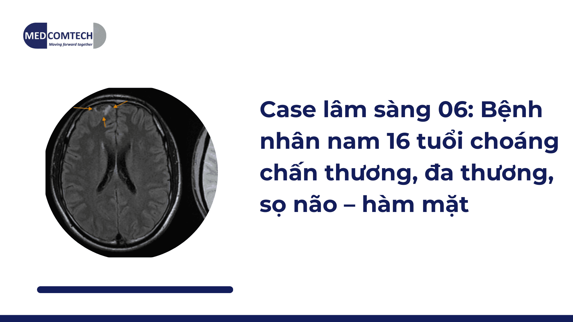Case lâm sàng 06: Bệnh nhân nam 16 tuổi choáng chấn thương, đa thương, sọ não – hàm mặt